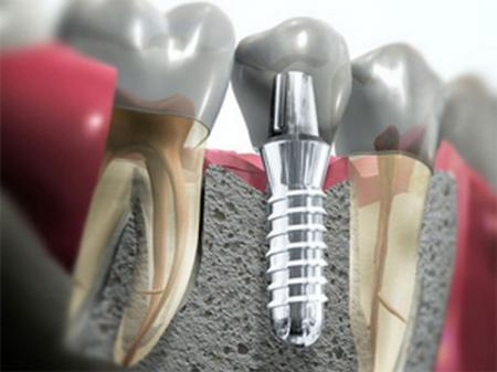 Имплантация зубных протезов