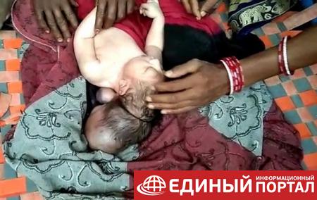 В Индии родился трехглавый младенец