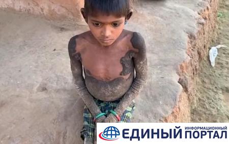 В Индии ребенок "окаменел" из-за редкой болезни