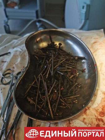 Врачи удалили из желудка мужчины килограмм гвоздей